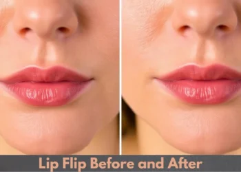 lip flip before and after experiences